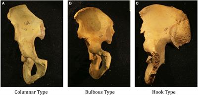 Prevalence of Anterior Inferior Iliac Spine Dysmorphism and Development of a Novel Classification System: An Anatomic Study of 1,797 Cadaveric Specimens